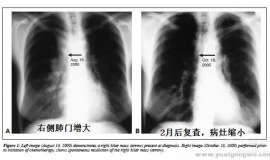 少数晚期肺癌不治疗也会自行好转，涨知识！