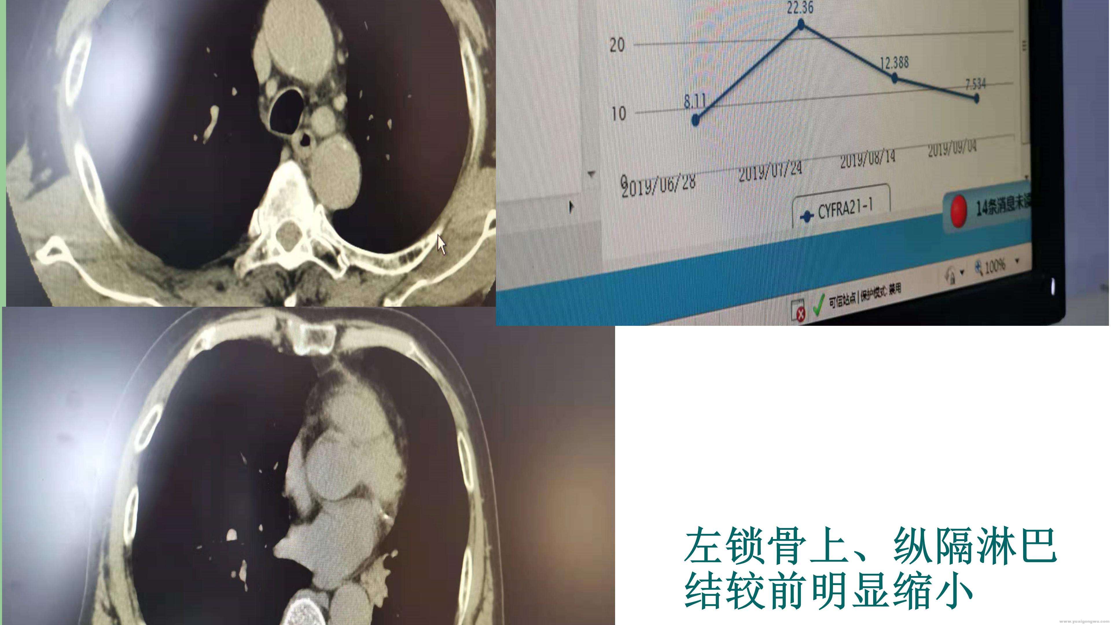 PD1病例分享_11.jpg